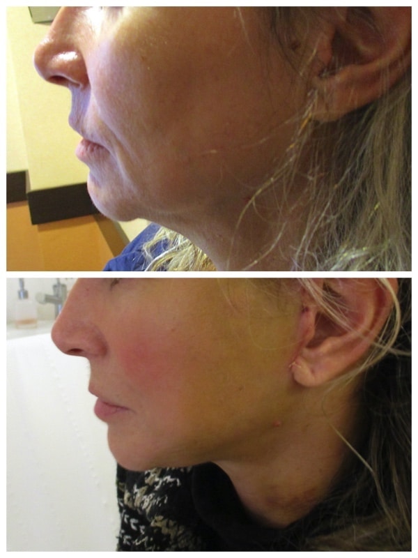 Traitement des rides naso-géniens, d'amertumes et du cou par un lifting superficiel du visage