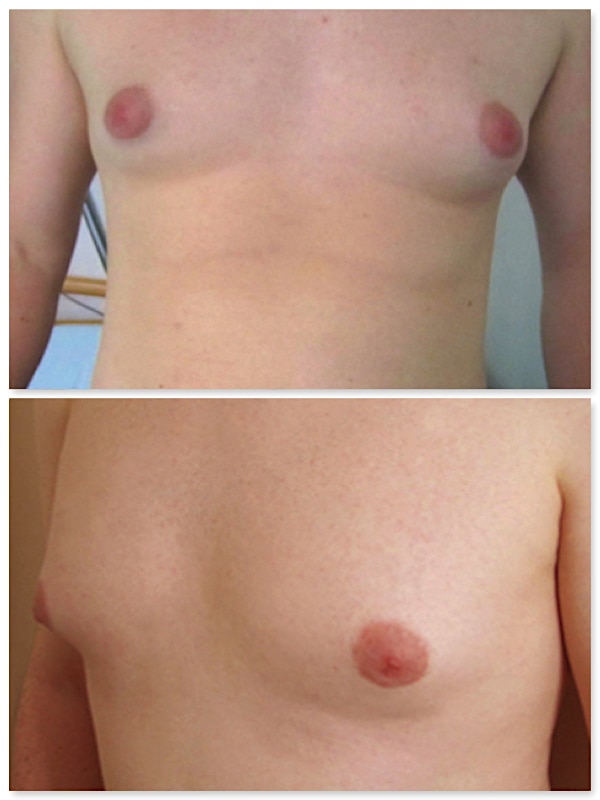 2 déclinaisons de seins chez l' homme : en haut, la véritable gynécomastie, en bas l'adipomastie