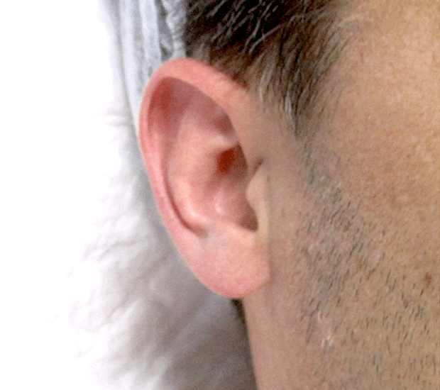 Aspect typique d'oreille décollée