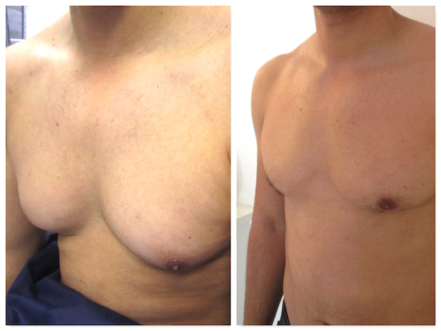 Opération traitant une hypertrophie graisseuse des seins chez l'homme : adipomastie