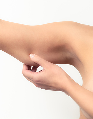 Le lifting des bras : la brachioplastie