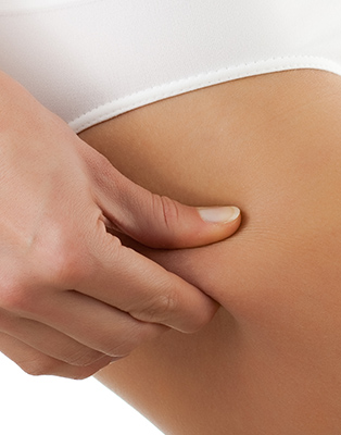 La liposuccion : l'aspiration des graisses