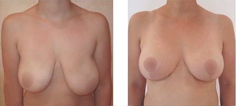 Reduction mammaire unilatérale pour correction asymétrie