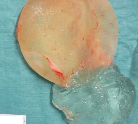 prothèse mammaire en gel de silicone, fuite de silicone cohésif