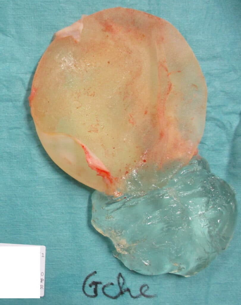 prothèse mammaire en gel de silicone, fuite de silicone cohésif