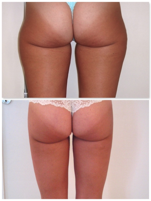 lipoaspiration de la culotte de cheval