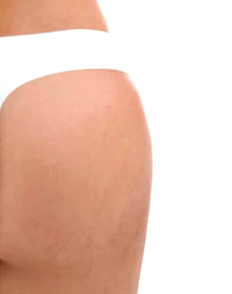 Le lipofilling des fesses