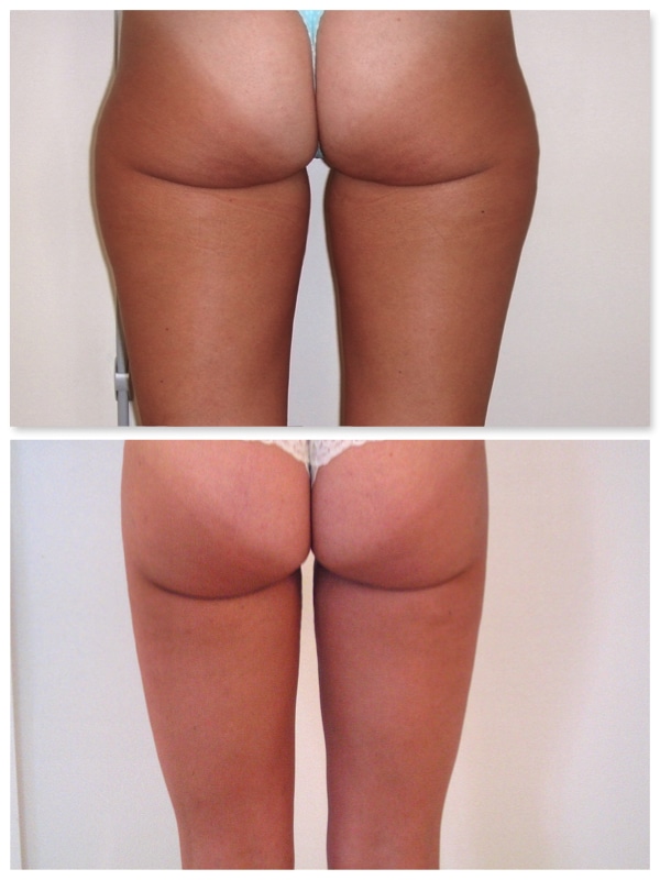 liposuccion culotte cheval fesses