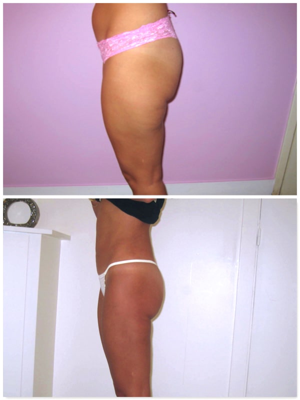 liposuccion flancs