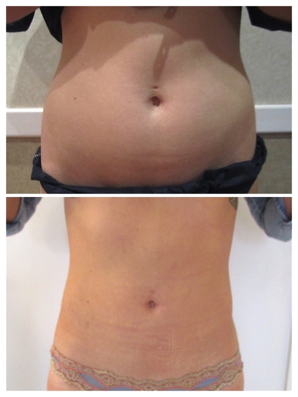 avant après liposuccion ventre taille femme