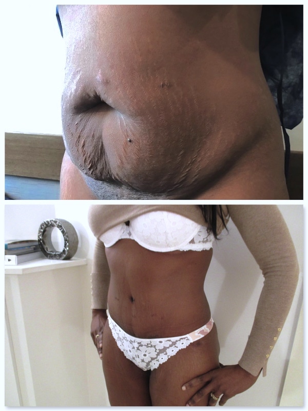 résultat abdominoplastie avec remise en tension musculaire