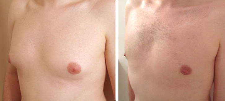 gyn&eacute;comastie : traitement hormonal andractim insuffisant