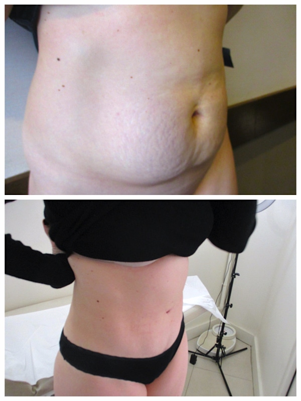 Résultat d'une abdominoplastie avec lipoaspiration après grossesse