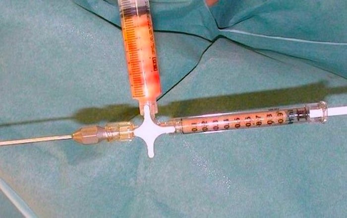 Seringue de cellules graisseuses de 1 ml prête
