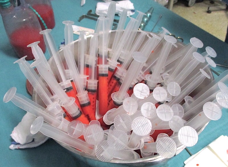 Photo de seringues de graisse centrifugée pretes pour un lipofilling des seins