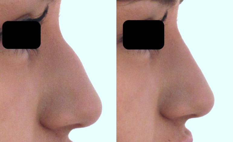 rhinoplastie médicale