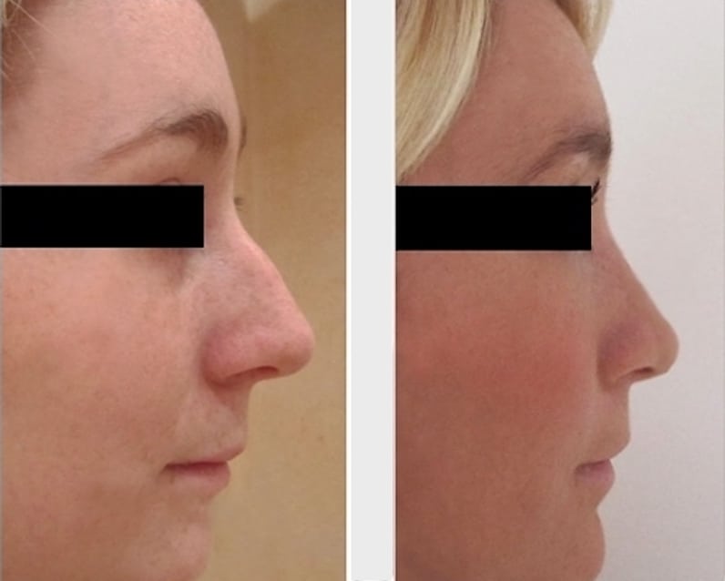 rhinoplastie génioplastie par implant