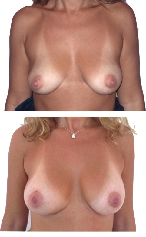 implant mammaire 240 cc