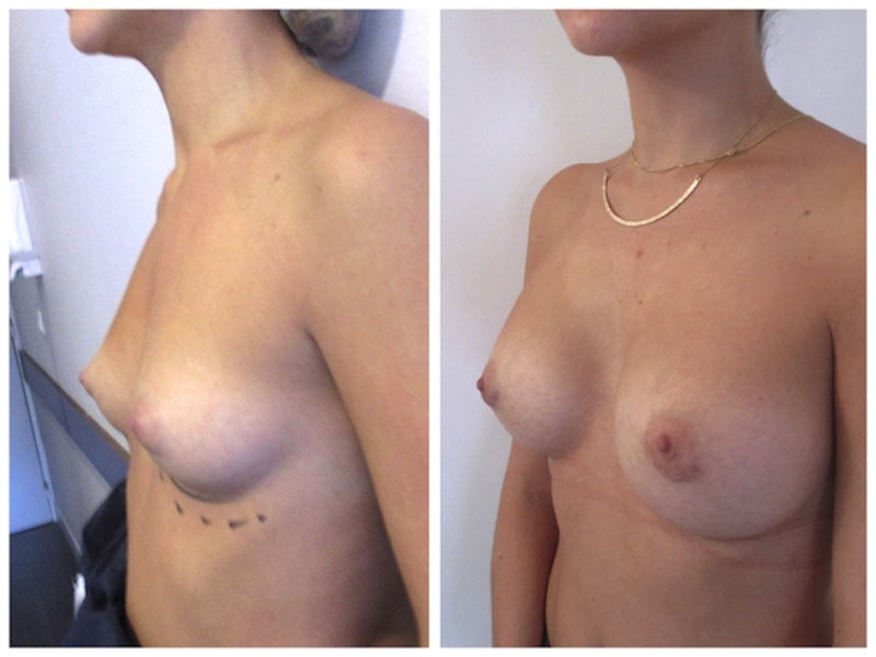 implants mammaires 300cc