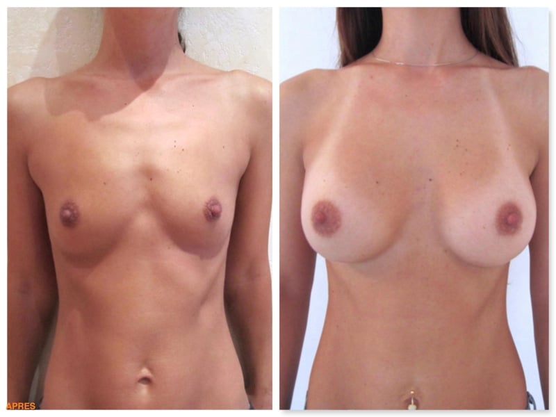 implants mammaires 280 cc