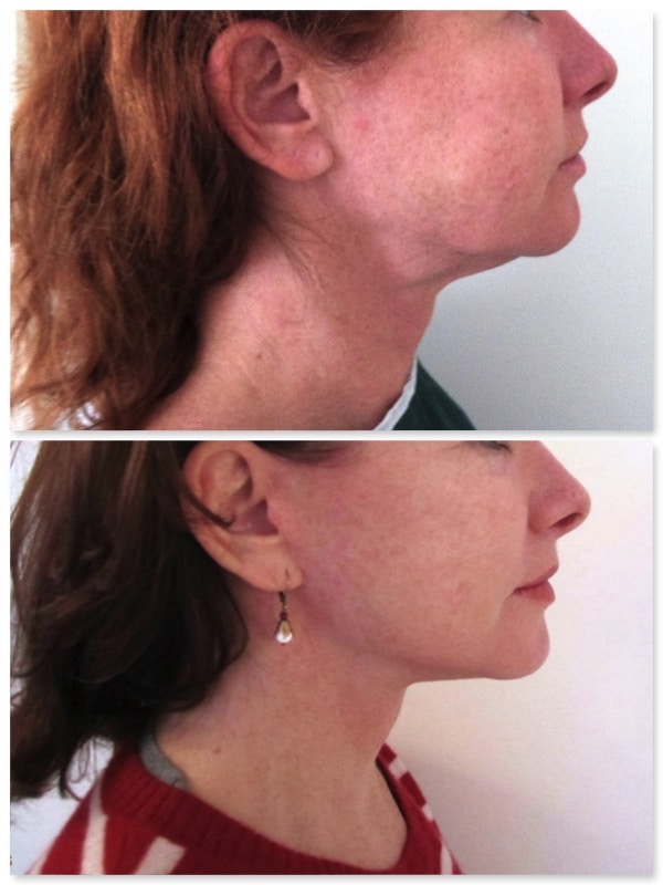 lifting bas du visage femme de 49 ans