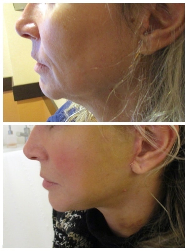 résultat lifting du visage au 6ème jour