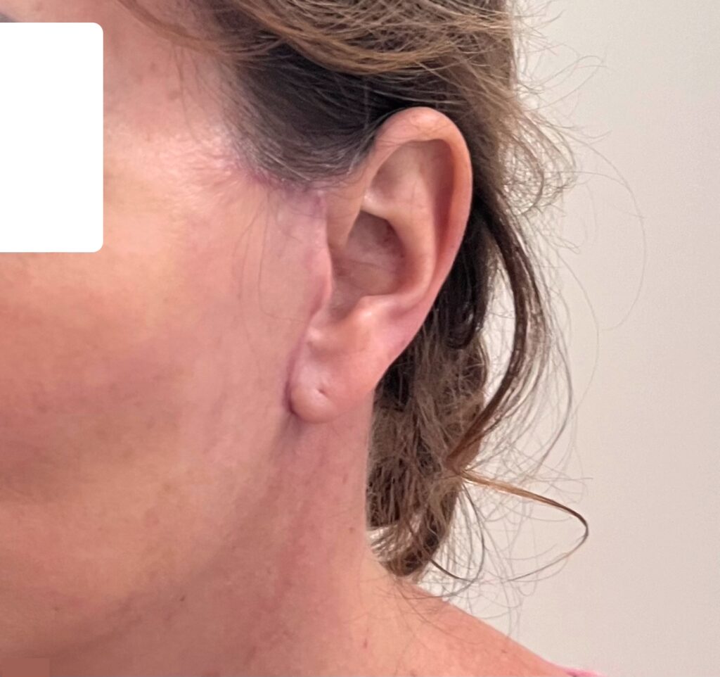 résultat lifting du visage au 11ème jour