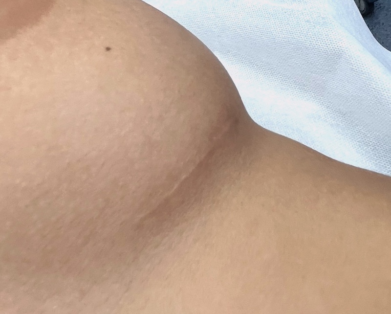 cicatrice sous-mammaire après augmentation par implants