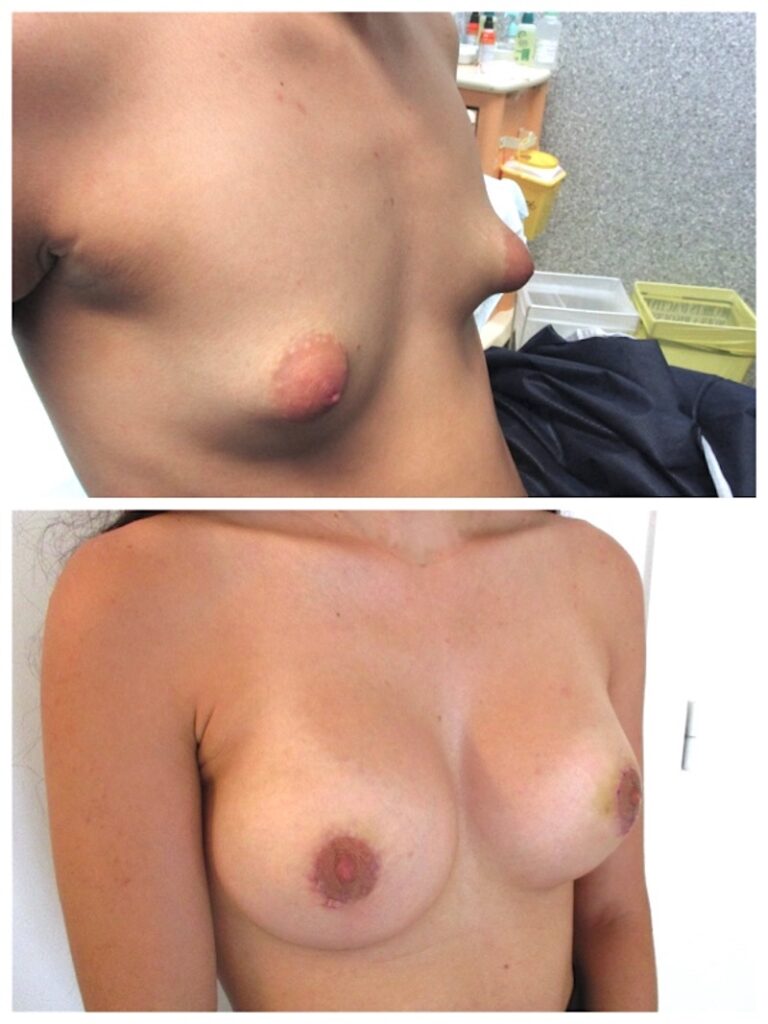 Correction des seins tub&eacute;reux par implants avec plastie ar&eacute;olaire