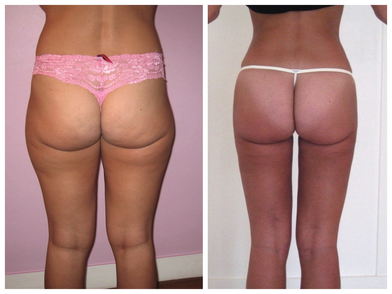 lipoaspiration sur plusieurs zones