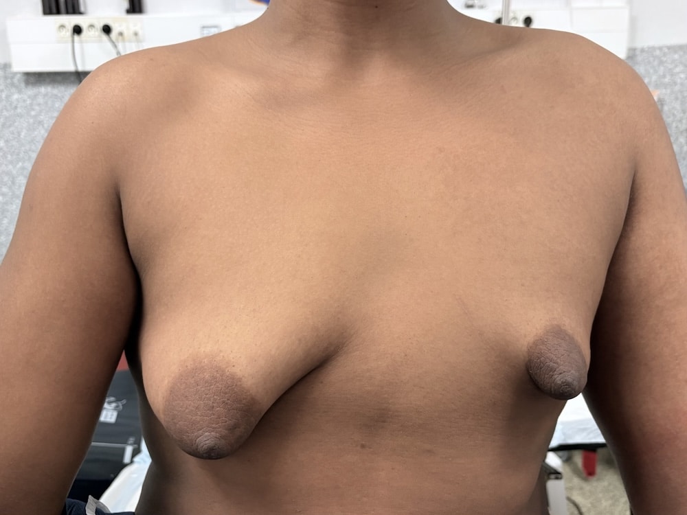 seins tubéreux avec forte asymétrie
