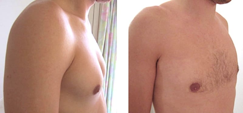 adipomastie homme lipoaspiration