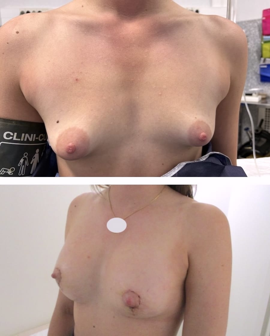 asymétrie mammaire hypotrophie sévère sein gauche (seins tubéreux)