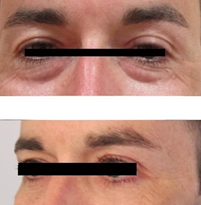 blépharoplastie inférieure homme